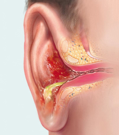 Ear Infections Treatment