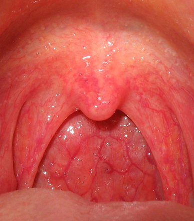 Throat Infection Treatment