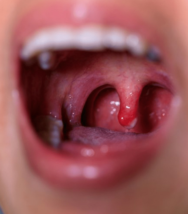 Voice Problems and Tonsillitis Treatment